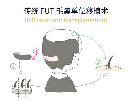 植发手术